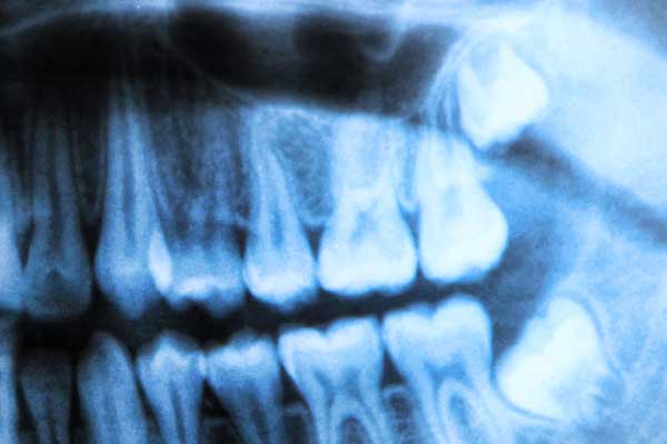 Wisdom Tooth Removal (3rd Molars)