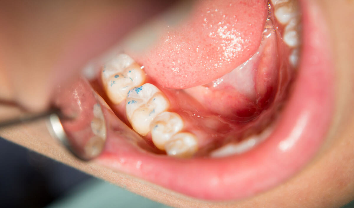 Impacted Tooth & Tooth Exposure