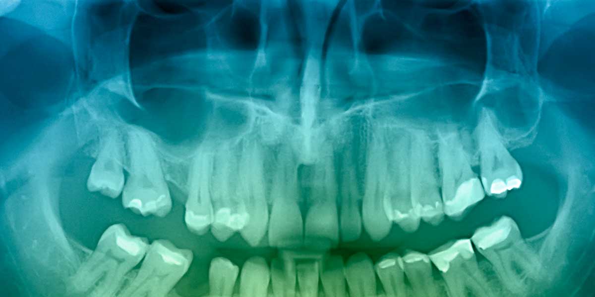 X-ray of upper arch and jaw and nasal cavity