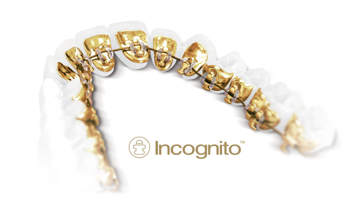 Incognito (tm) Braces