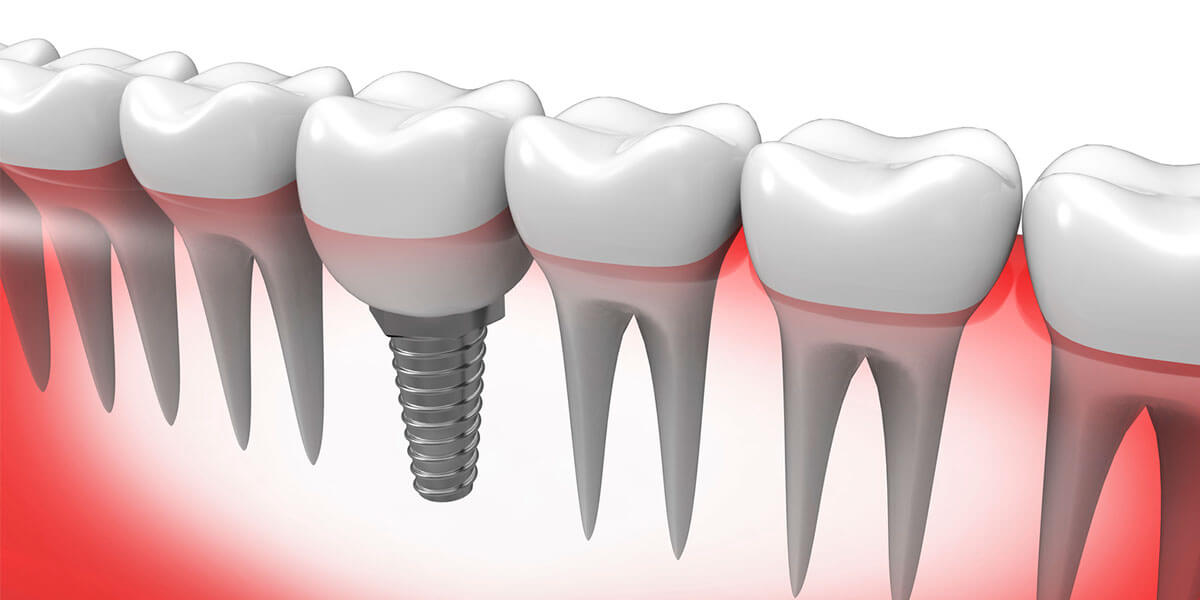 Dental Implants